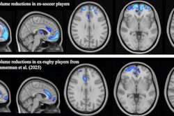 Voxel-based morphometry (VBM) group comparison of grey matter brain volumes. TFCE-corrected significance map shown (one-tailed t-test; higher significance indicated by light blue color). (a) Comparison between ex-soccer players (n = 124) and controls (n = 40). (b) Comparison between ex-rugby players (n = 200) and controls (n = 33) from Graham & Zimmerman et al. (2025), reproduced with permission under Creative Commons license.