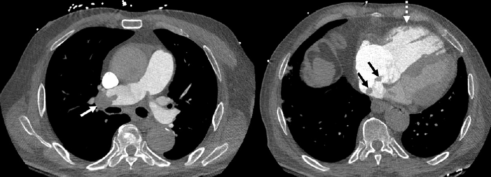 Acute pulmonary embolism (PE) with right ventricle (RV) enlargement and clot-in-transit. PE chest axial CT angiography images demonstrate pulmonary embolus in the right pulmonary artery (white solid arrow), an enlarged RV (dotted arrow), and thrombus transiting through the right atrium (black arrows), PE-RADS 4/RV+/T+. The &ldquo;4&rdquo; refers to the PE‑RADS ordinal category for the most proximal clot location (central arteries). &ldquo;RV+&rdquo; indicates RV enlargement (RV to left ventricle ratio &ge; 1.0). &ldquo;T+&rdquo; indicates definitive thrombus identified in the right atrium and/or RV.