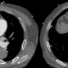 Acute pulmonary embolism (PE) with right ventricle (RV) enlargement and clot-in-transit. PE chest axial CT angiography images demonstrate pulmonary embolus in the right pulmonary artery (white solid arrow), an enlarged RV (dotted arrow), and thrombus transiting through the right atrium (black arrows), PE-RADS 4/RV+/T+. The “4” refers to the PE‑RADS ordinal category for the most proximal clot location (central arteries). “RV+” indicates RV enlargement (RV to left ventricle ratio ≥ 1.0). “T+” indicates definitive thrombus identified in the right atrium and/or RV.