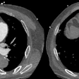 Acute pulmonary embolism (PE) with right ventricle (RV) enlargement and clot-in-transit. PE chest axial CT angiography images demonstrate pulmonary embolus in the right pulmonary artery (white solid arrow), an enlarged RV (dotted arrow), and thrombus transiting through the right atrium (black arrows), PE-RADS 4/RV+/T+. The “4” refers to the PE‑RADS ordinal category for the most proximal clot location (central arteries). “RV+” indicates RV enlargement (RV to left ventricle ratio ≥ 1.0). “T+” indicates definitive thrombus identified in the right atrium and/or RV.