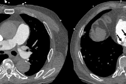 Acute pulmonary embolism (PE) with right ventricle (RV) enlargement and clot-in-transit. PE chest axial CT angiography images demonstrate pulmonary embolus in the right pulmonary artery (white solid arrow), an enlarged RV (dotted arrow), and thrombus transiting through the right atrium (black arrows), PE-RADS 4/RV+/T+. The “4” refers to the PE‑RADS ordinal category for the most proximal clot location (central arteries). “RV+” indicates RV enlargement (RV to left ventricle ratio ≥ 1.0). “T+” indicates definitive thrombus identified in the right atrium and/or RV.