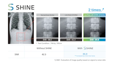 Internal benchmark testing under standard radiographic parameters showed that Shine increased the signal-to-noise ratio on x-ray images.