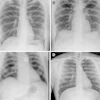 Representative preflight, in-flight, and postflight chest radiographs. Radiographs of the chest were acquired (A) preflight by a crewmember, (B, C) in-flight on day 3 after launch (L+3) by a crewmember, and (D) postflight by a non-crew operator using the same imaging protocol.