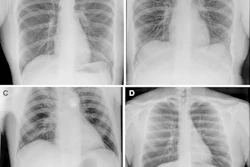 Representative preflight, in-flight, and postflight chest radiographs. Radiographs of the chest were acquired (A) preflight by a crewmember, (B, C) in-flight on day 3 after launch (L+3) by a crewmember, and (D) postflight by a non-crew operator using the same imaging protocol.
