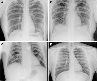 Representative preflight, in-flight, and postflight chest radiographs. Radiographs of the chest were acquired (A) preflight by a crewmember, (B, C) in-flight on day 3 after launch (L+3) by a crewmember, and (D) postflight by a non-crew operator using the same imaging protocol.