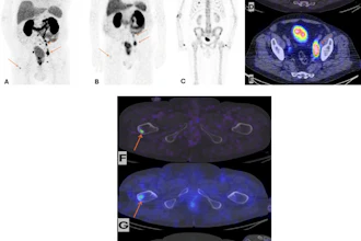 Maximum intensity projection of Ga-68 PSMA-11 PET/CE-CT (A), Tc-99m MIP-1404 CZT SPECT/CT (B) and Tc-99m HDP CZT SPECT/CT (C) imaging. Ga-68 PSMA-11 PET/CE-CT and Tc-99m MIP-1404 CZT SPECT/CT showing tracer uptake in lymph nodes below the iliac bifurcation and above, paraaortic and left supraclavicular, bone uptake in the right proximal femur and right scapula (arrows). Tc-99m HDP CZT SPECT/CT did not show any uptake suspicious for metastatic disease. No sclerotic lesions suspicious of metastases were detected by the CT component in any of the studies. Fusion axial imaging of Ga-68 PSMA-11 PET/CE-CT (D) and Tc-99m MIP-1404 CZT SPECT/CT (E) showing uptake in lymph nodes in the left pelvic area below the iliac bifurcation (arrows). Fusion axial imaging of Ga-68 PSMA-11 PET/CE-CT (F) and Tc-99m MIP-1404 CZT SPECT/CT (G) showing uptake in the right proximal femur, not detected by Tc-99m HDP CZT SPECT/CT (H), (arrows).