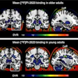 F-18 PI-2620 average binding potential maps. Mean tracer binding (DVR) image from 165 older adults (A) and 13 young adults (B). Images are scaled from 1 to 1.8 for display purposes, but DVR values of less than 1 were frequently observed.