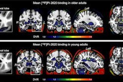 F-18 PI-2620 average binding potential maps. Mean tracer binding (DVR) image from 165 older adults (A) and 13 young adults (B). Images are scaled from 1 to 1.8 for display purposes, but DVR values of less than 1 were frequently observed.