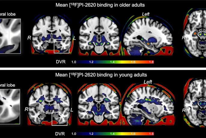 F-18 PI-2620 average binding potential maps. Mean tracer binding (DVR) image from 165 older adults (A) and 13 young adults (B). Images are scaled from 1 to 1.8 for display purposes, but DVR values of less than 1 were frequently observed.