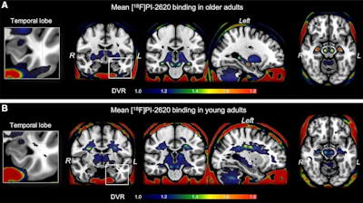 F-18 PI-2620 average binding potential maps. Mean tracer binding (DVR) image from 165 older adults (A) and 13 young adults (B). Images are scaled from 1 to 1.8 for display purposes, but DVR values of less than 1 were frequently observed. F-18 PI-2620 average binding potential maps. Mean tracer binding (DVR) image from 165 older adults (A) and 13 young adults (B). Images are scaled from 1 to 1.8 for display purposes, but DVR values of less than 1 were frequently observed.
