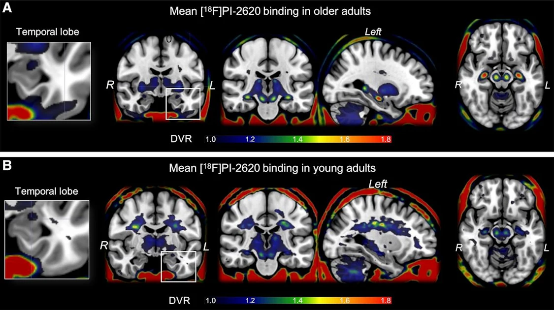 Tau PET tracer flags early Alzheimer risk in healthy older adults