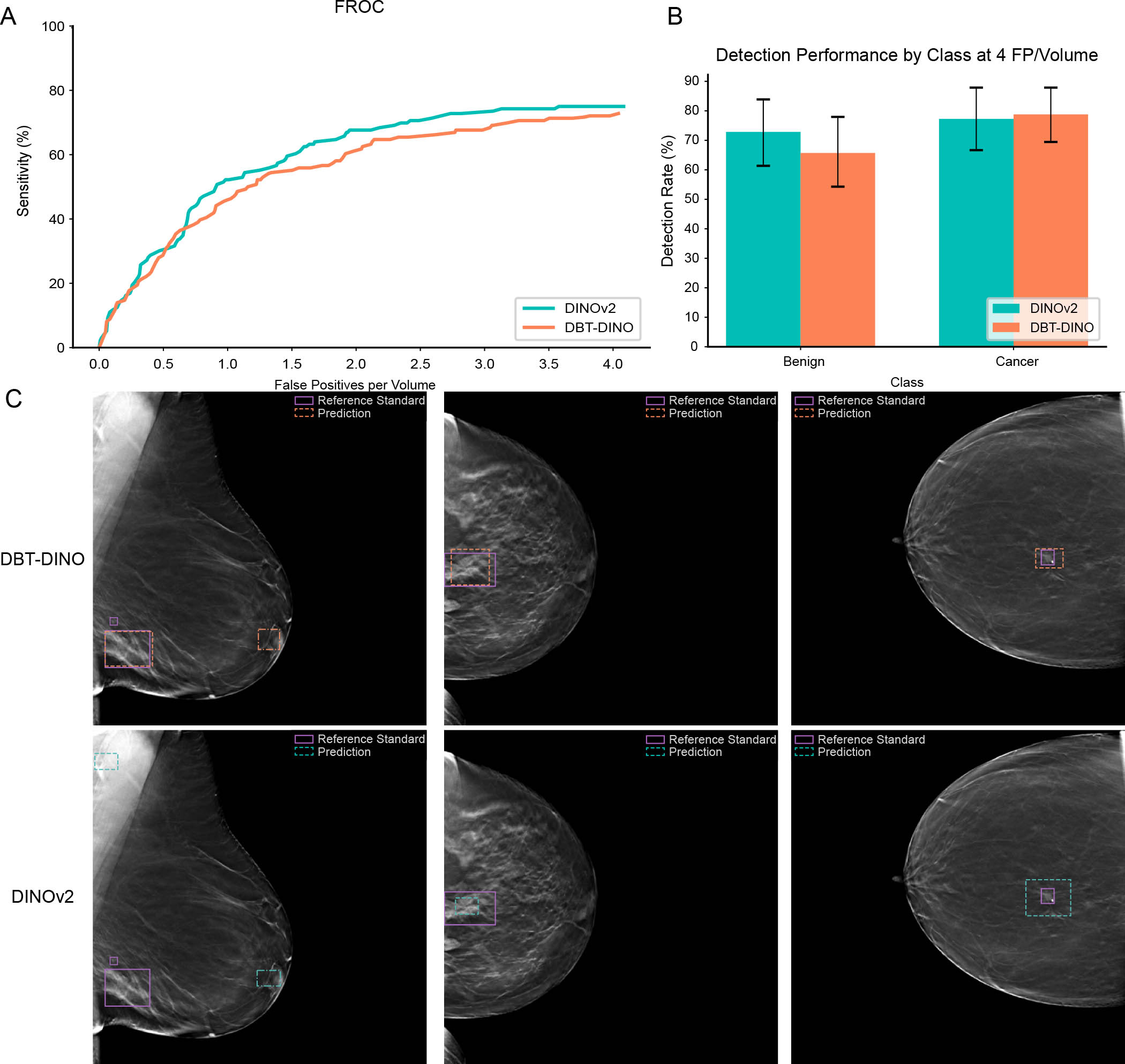 (A) Free-response receiver operating characteristic (FROC) curve for DBT-DINO and DINOv2 (Meta AI) on the detection task. DINOv2 achieved higher sensitivity than DBT-DINO across most false-positive thresholds. (B) Detection rates of DBT-DINO and DINOv2 for lesions that were ultimately found to be benign (n = 70) and lesions that were found to be cancerous (n = 66). Error bars represent 95% CIs estimated via patient-level bootstrapping with 1000 repetitions. Both models showed similar detection rates for cancerous lesions, whereas DINOv2 detected more benign lesions than DBT-DINO. (C) Example bounding box predictions for DBT-DINO and DINOv2 on the detection test set. Each image is a single two-dimensional section from a three-dimensional digital breast tomosynthesis volume; the first column shows a mediolateral oblique view, and the second and third columns show craniocaudal views. Both models struggled to detect very small lesions, such as the 3-mm-diameter lesion shown in the first column. FP = false positive.