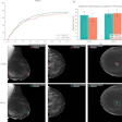 (A) Free-response receiver operating characteristic (FROC) curve for DBT-DINO and DINOv2 (Meta AI) on the detection task. DINOv2 achieved higher sensitivity than DBT-DINO across most false-positive thresholds. (B) Detection rates of DBT-DINO and DINOv2 for lesions that were ultimately found to be benign (n = 70) and lesions that were found to be cancerous (n = 66). Error bars represent 95% CIs estimated via patient-level bootstrapping with 1000 repetitions. Both models showed similar detection rates for cancerous lesions, whereas DINOv2 detected more benign lesions than DBT-DINO. (C) Example bounding box predictions for DBT-DINO and DINOv2 on the detection test set. Each image is a single two-dimensional section from a three-dimensional digital breast tomosynthesis volume; the first column shows a mediolateral oblique view, and the second and third columns show craniocaudal views. Both models struggled to detect very small lesions, such as the 3-mm-diameter lesion shown in the first column. FP = false positive.