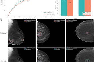 (A) Free-response receiver operating characteristic (FROC) curve for DBT-DINO and DINOv2 (Meta AI) on the detection task. DINOv2 achieved higher sensitivity than DBT-DINO across most false-positive thresholds. (B) Detection rates of DBT-DINO and DINOv2 for lesions that were ultimately found to be benign (n = 70) and lesions that were found to be cancerous (n = 66). Error bars represent 95% CIs estimated via patient-level bootstrapping with 1000 repetitions. Both models showed similar detection rates for cancerous lesions, whereas DINOv2 detected more benign lesions than DBT-DINO. (C) Example bounding box predictions for DBT-DINO and DINOv2 on the detection test set. Each image is a single two-dimensional section from a three-dimensional digital breast tomosynthesis volume; the first column shows a mediolateral oblique view, and the second and third columns show craniocaudal views. Both models struggled to detect very small lesions, such as the 3-mm-diameter lesion shown in the first column. FP = false positive.