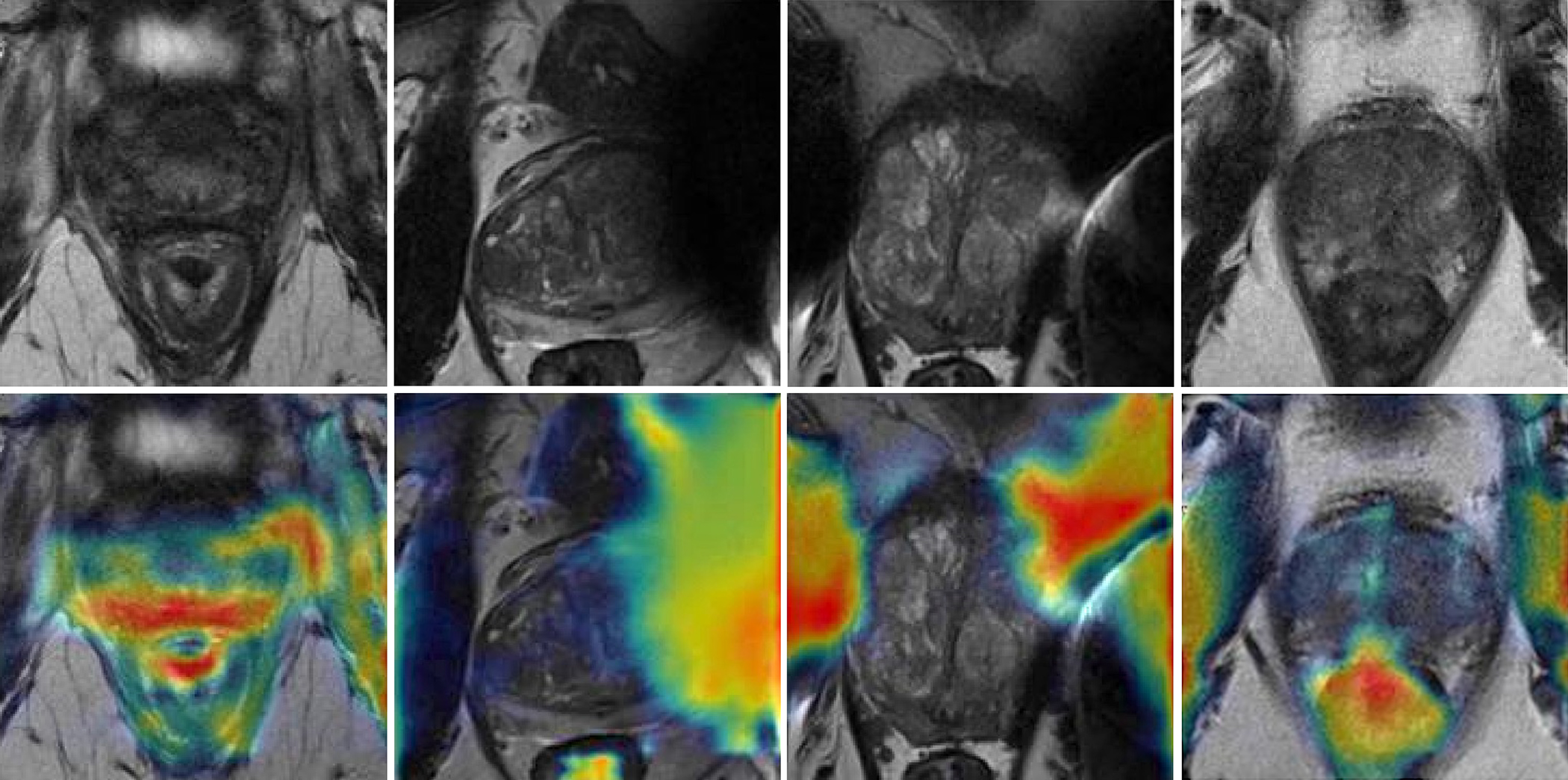 Low-quality axial T2-weighted MRI scans with gradient-weighted class activation mapping. The low-quality MRI scans (top row) show blurred structures and artifacts making zonal and capsule boundaries indistinguishable. On the same scans with gradient-weighted class activation map overlays (bottom row), red indicates regions that were most heavily weighted by the deep learning model toward the low-quality prediction.