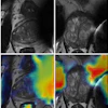 Low-quality axial T2-weighted MRI scans with gradient-weighted class activation mapping. The low-quality MRI scans (top row) show blurred structures and artifacts making zonal and capsule boundaries indistinguishable. On the same scans with gradient-weighted class activation map overlays (bottom row), red indicates regions that were most heavily weighted by the deep learning model toward the low-quality prediction.