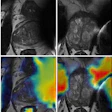 Low-quality axial T2-weighted MRI scans with gradient-weighted class activation mapping. The low-quality MRI scans (top row) show blurred structures and artifacts making zonal and capsule boundaries indistinguishable. On the same scans with gradient-weighted class activation map overlays (bottom row), red indicates regions that were most heavily weighted by the deep learning model toward the low-quality prediction.