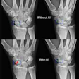 Artificial intelligence (AI) assistance facilitates correct fracture identification in cases initially missed by human readers. A representative case is shown using anteroposterior radiographs in a 29-year-old male patient with wrist trauma (suspected nondisplaced transverse scaphoid fracture). The reader’s initial unaided assessment (top) resulted in a missed fracture, whereas with AI assistance (bottom), the fracture was correctly identified. The green box represents the fracture location as predicted by the AI tool, the blue box represents the reference standard annotation, and the red dots represent individual reader annotations.