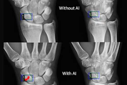 Artificial intelligence (AI) assistance facilitates correct fracture identification in cases initially missed by human readers. A representative case is shown using anteroposterior radiographs in a 29-year-old male patient with wrist trauma (suspected nondisplaced transverse scaphoid fracture). The reader’s initial unaided assessment (top) resulted in a missed fracture, whereas with AI assistance (bottom), the fracture was correctly identified. The green box represents the fracture location as predicted by the AI tool, the blue box represents the reference standard annotation, and the red dots represent individual reader annotations.