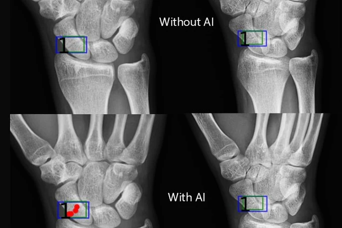 Artificial intelligence (AI) assistance facilitates correct fracture identification in cases initially missed by human readers. A representative case is shown using anteroposterior radiographs in a 29-year-old male patient with wrist trauma (suspected nondisplaced transverse scaphoid fracture). The reader’s initial unaided assessment (top) resulted in a missed fracture, whereas with AI assistance (bottom), the fracture was correctly identified. The green box represents the fracture location as predicted by the AI tool, the blue box represents the reference standard annotation, and the red dots represent individual reader annotations.