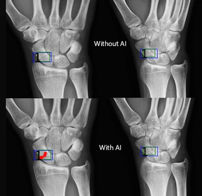 Artificial intelligence (AI) assistance facilitates correct fracture identification in cases initially missed by human readers. A representative case is shown using anteroposterior radiographs in a 29-year-old male patient with wrist trauma (suspected nondisplaced transverse scaphoid fracture). The reader’s initial unaided assessment (top) resulted in a missed fracture, whereas with AI assistance (bottom), the fracture was correctly identified. The green box represents the fracture location as predicted by the AI tool, the blue box represents the reference standard annotation, and the red dots represent individual reader annotations.