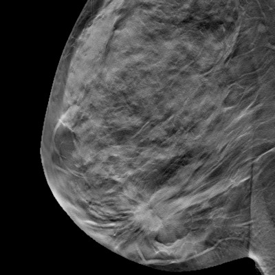 Breast Dbt 400