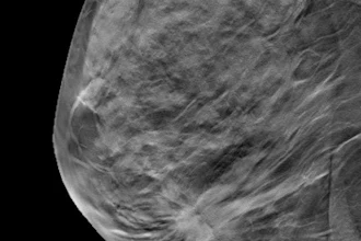 Breast Dbt 400
