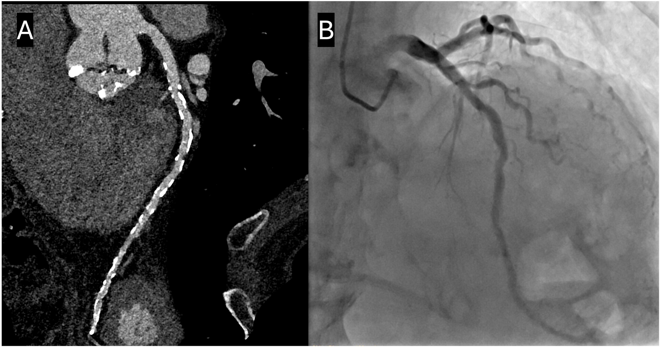 Representative case from the non-nitroglycerin cohort. A 92-year-old man who did not receive sublingual nitroglycerin because of severe aortic stenosis. The Agatston coronary artery calcium score was 5438. (A) Curved multiplanar reformatted CCTA image reconstructed at 0.4-mm slice thickness using a Bv60 kernel and QIR strength 3 demonstrates diffuse multifocal mild luminal stenoses related to extensive calcified atherosclerotic plaque. (B) Invasive coronary angiography confirmed multifocal mild stenoses without evidence of obstructive coronary artery disease.