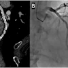 Representative case from the non-nitroglycerin cohort. A 92-year-old man who did not receive sublingual nitroglycerin because of severe aortic stenosis. The Agatston coronary artery calcium score was 5438. (A) Curved multiplanar reformatted CCTA image reconstructed at 0.4-mm slice thickness using a Bv60 kernel and QIR strength 3 demonstrates diffuse multifocal mild luminal stenoses related to extensive calcified atherosclerotic plaque. (B) Invasive coronary angiography confirmed multifocal mild stenoses without evidence of obstructive coronary artery disease.