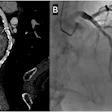 Representative case from the non-nitroglycerin cohort. A 92-year-old man who did not receive sublingual nitroglycerin because of severe aortic stenosis. The Agatston coronary artery calcium score was 5438. (A) Curved multiplanar reformatted CCTA image reconstructed at 0.4-mm slice thickness using a Bv60 kernel and QIR strength 3 demonstrates diffuse multifocal mild luminal stenoses related to extensive calcified atherosclerotic plaque. (B) Invasive coronary angiography confirmed multifocal mild stenoses without evidence of obstructive coronary artery disease.