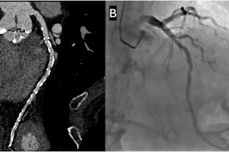Representative case from the non-nitroglycerin cohort. A 92-year-old man who did not receive sublingual nitroglycerin because of severe aortic stenosis. The Agatston coronary artery calcium score was 5438. (A) Curved multiplanar reformatted CCTA image reconstructed at 0.4-mm slice thickness using a Bv60 kernel and QIR strength 3 demonstrates diffuse multifocal mild luminal stenoses related to extensive calcified atherosclerotic plaque. (B) Invasive coronary angiography confirmed multifocal mild stenoses without evidence of obstructive coronary artery disease.