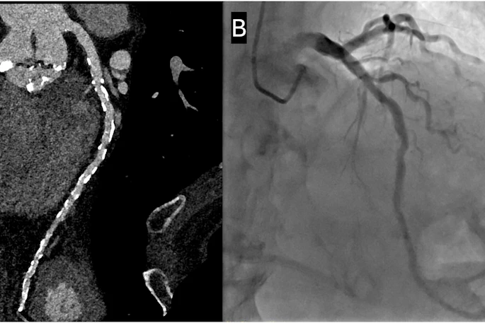 Representative case from the non-nitroglycerin cohort. A 92-year-old man who did not receive sublingual nitroglycerin because of severe aortic stenosis. The Agatston coronary artery calcium score was 5438. (A) Curved multiplanar reformatted CCTA image reconstructed at 0.4-mm slice thickness using a Bv60 kernel and QIR strength 3 demonstrates diffuse multifocal mild luminal stenoses related to extensive calcified atherosclerotic plaque. (B) Invasive coronary angiography confirmed multifocal mild stenoses without evidence of obstructive coronary artery disease.