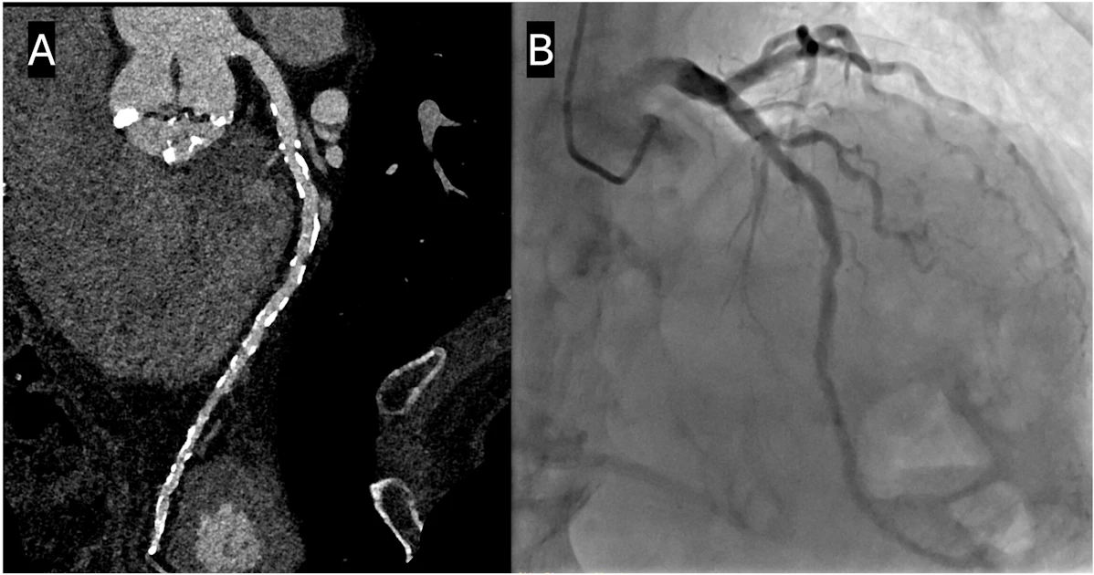 Is nitroglycerin necessary prior to photon-counting CT?