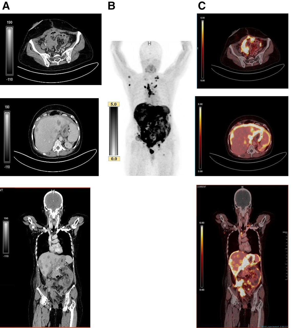 Comparison of contrast-enhanced CT (ceCT) and FAPI-PET in detecting peritoneal carcinomatosis in patient with advanced ovarian carcinoma. (A) ceCT shows subtle peritoneal thickening that is difficult to delineate. (B) Maximum-intensity-projection image demonstrating diffuse intense FAPI uptake corresponding to extensive peritoneal carcinomatosis. (C) FAPI-PET shows intense uptake corresponding with peritoneal carcinomatosis, with improved lesion conspicuity over ceCT.