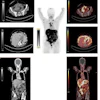 Comparison of contrast-enhanced CT (ceCT) and FAPI-PET in detecting peritoneal carcinomatosis in patient with advanced ovarian carcinoma. (A) ceCT shows subtle peritoneal thickening that is difficult to delineate. (B) Maximum-intensity-projection image demonstrating diffuse intense FAPI uptake corresponding to extensive peritoneal carcinomatosis. (C) FAPI-PET shows intense uptake corresponding with peritoneal carcinomatosis, with improved lesion conspicuity over ceCT.