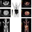 Comparison of contrast-enhanced CT (ceCT) and FAPI-PET in detecting peritoneal carcinomatosis in patient with advanced ovarian carcinoma. (A) ceCT shows subtle peritoneal thickening that is difficult to delineate. (B) Maximum-intensity-projection image demonstrating diffuse intense FAPI uptake corresponding to extensive peritoneal carcinomatosis. (C) FAPI-PET shows intense uptake corresponding with peritoneal carcinomatosis, with improved lesion conspicuity over ceCT.