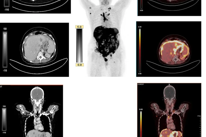 Comparison of contrast-enhanced CT (ceCT) and FAPI-PET in detecting peritoneal carcinomatosis in patient with advanced ovarian carcinoma. (A) ceCT shows subtle peritoneal thickening that is difficult to delineate. (B) Maximum-intensity-projection image demonstrating diffuse intense FAPI uptake corresponding to extensive peritoneal carcinomatosis. (C) FAPI-PET shows intense uptake corresponding with peritoneal carcinomatosis, with improved lesion conspicuity over ceCT.