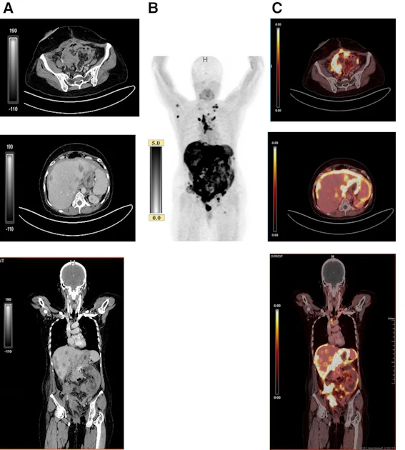 PET outperforms CT in ovarian cancer