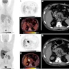 Shown is a 69-year-old man with a cholangiocarcinoma in the distal common bile duct. F-18 FDG-PET/CT was negative where Ga-68 FAPI-46 PET/CT showed high focal FAPI uptake in the liver hilum and surrounding lymph nodes. a-d: F-18 FDG-PET/CT, e-h: Ga-68 FAPI-46 PET/CT. a, b, e, f: Maximum intensity projections, c, g: axial fusion images, d, h: non-contrast enhanced CT.
