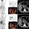 Shown is a 69-year-old man with a cholangiocarcinoma in the distal common bile duct. F-18 FDG-PET/CT was negative where Ga-68 FAPI-46 PET/CT showed high focal FAPI uptake in the liver hilum and surrounding lymph nodes. a-d: F-18 FDG-PET/CT, e-h: Ga-68 FAPI-46 PET/CT. a, b, e, f: Maximum intensity projections, c, g: axial fusion images, d, h: non-contrast enhanced CT.