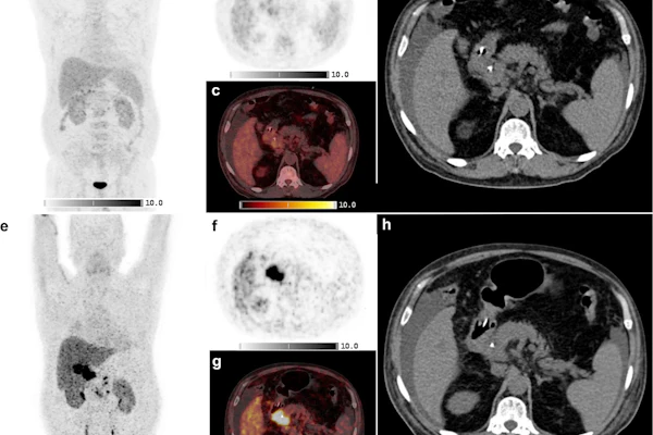 Shown is a 69-year-old man with a cholangiocarcinoma in the distal common bile duct. F-18 FDG-PET/CT was negative where Ga-68 FAPI-46 PET/CT showed high focal FAPI uptake in the liver hilum and surrounding lymph nodes. a-d: F-18 FDG-PET/CT, e-h: Ga-68 FAPI-46 PET/CT. a, b, e, f: Maximum intensity projections, c, g: axial fusion images, d, h: non-contrast enhanced CT.