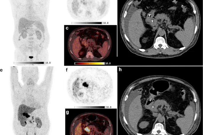 Shown is a 69-year-old man with a cholangiocarcinoma in the distal common bile duct. F-18 FDG-PET/CT was negative where Ga-68 FAPI-46 PET/CT showed high focal FAPI uptake in the liver hilum and surrounding lymph nodes. a-d: F-18 FDG-PET/CT, e-h: Ga-68 FAPI-46 PET/CT. a, b, e, f: Maximum intensity projections, c, g: axial fusion images, d, h: non-contrast enhanced CT.