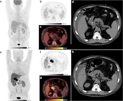 Shown is a 69-year-old man with a cholangiocarcinoma in the distal common bile duct. F-18 FDG-PET/CT was negative where Ga-68 FAPI-46 PET/CT showed high focal FAPI uptake in the liver hilum and surrounding lymph nodes. a-d: F-18 FDG-PET/CT, e-h: Ga-68 FAPI-46 PET/CT. a, b, e, f: Maximum intensity projections, c, g: axial fusion images, d, h: non-contrast enhanced CT.