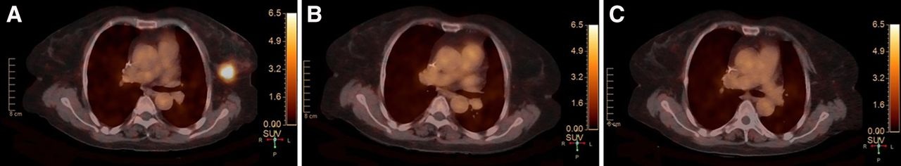 Ga-68 HER2-PET/CT images before neoadjuvant therapy, at end of second cycle, and before surgery. (A) Baseline scan demonstrated soft-tissue lesion measuring approximately 2.3 × 2.2 cm in upper outer quadrant of left breast, with marked radiotracer uptake and SUVmax of 10.1. (B) At end of second cycle, imaging revealed residual lesion of approximately 2.2 × 1.0 cm in same region, without abnormal radiotracer accumulation. (C) Preoperative imaging demonstrated further reduction in lesion size to approximately 2.0 × 0.6 cm, with no abnormal tracer uptake detected.