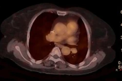 Ga-68 HER2-PET/CT images before neoadjuvant therapy, at end of second cycle, and before surgery. (A) Baseline scan demonstrated soft-tissue lesion measuring approximately 2.3 × 2.2 cm in upper outer quadrant of left breast, with marked radiotracer uptake and SUVmax of 10.1. (B) At end of second cycle, imaging revealed residual lesion of approximately 2.2 × 1.0 cm in same region, without abnormal radiotracer accumulation. (C) Preoperative imaging demonstrated further reduction in lesion size to approximately 2.0 × 0.6 cm, with no abnormal tracer uptake detected.