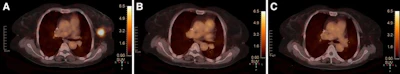Ga-68 HER2-PET/CT images before neoadjuvant therapy, at end of second cycle, and before surgery. (A) Baseline scan demonstrated soft-tissue lesion measuring approximately 2.3 × 2.2 cm in upper outer quadrant of left breast, with marked radiotracer uptake and SUVmax of 10.1. (B) At end of second cycle, imaging revealed residual lesion of approximately 2.2 × 1.0 cm in same region, without abnormal radiotracer accumulation. (C) Preoperative imaging demonstrated further reduction in lesion size to approximately 2.0 × 0.6 cm, with no abnormal tracer uptake detected.