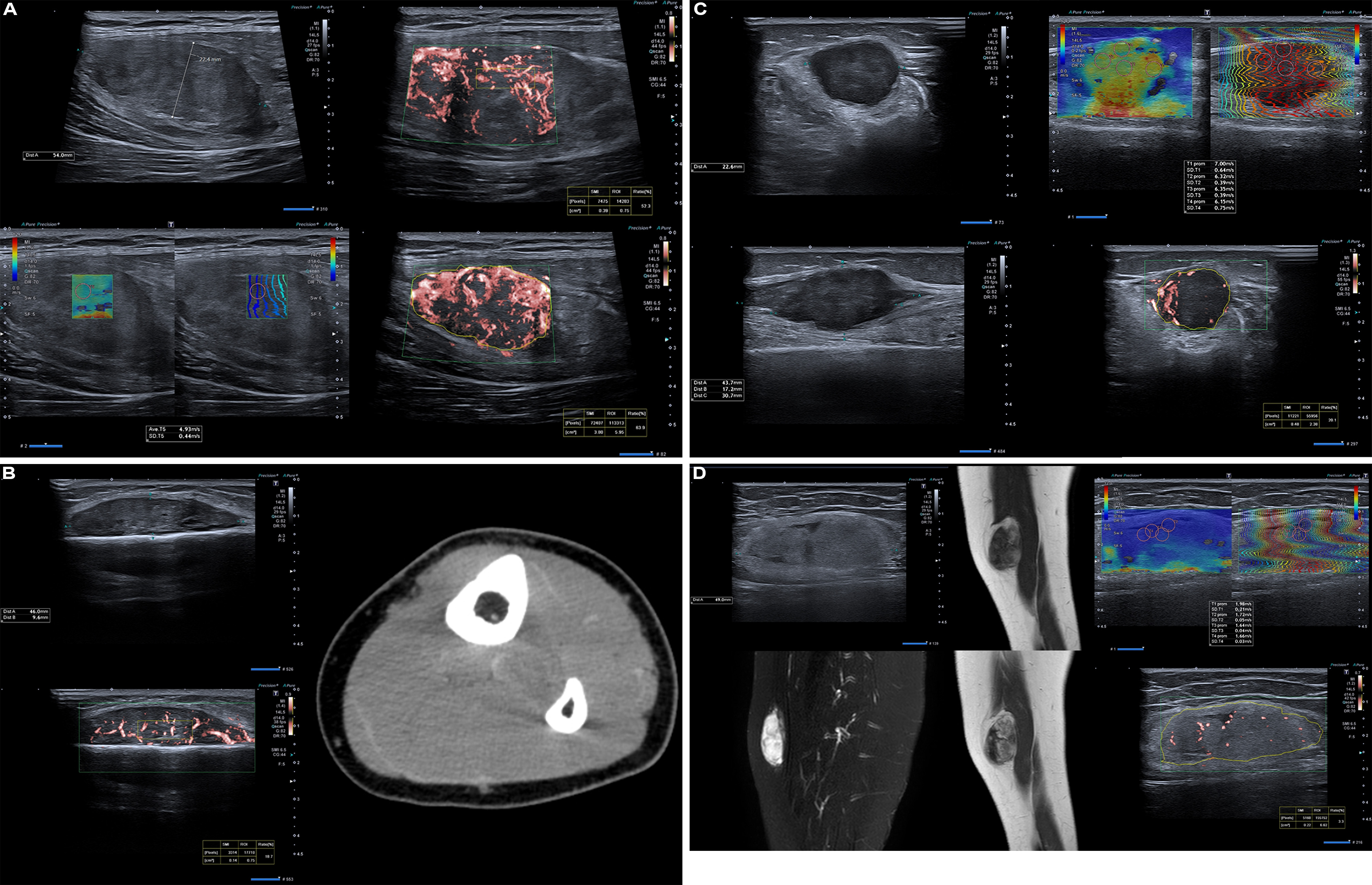 Examples of ultrasound findings and techniques. (A) Images in a 39-year-old male patient with a mass in the left thigh. The mass is heterogeneous on the B-mode US image (compared with the patient in D) and showed increased microvascularity (superb microvascular imaging [SMI]) and shear-wave elastography (SWE) values. Undifferentiated pleomorphic sarcoma was diagnosed at biopsy (with pleomorphic rhabdomyosarcoma in surgical specimen). (B) Images in an 18-year-old male patient with a mass in the left leg. The mass is hypoechoic on the B-mode image, with no other findings suggestive of malignancy. The lesion is in contact with the cortex of the tibia, which is slightly irregular. CT revealed a doubtful anteromedial tibial erosion. The microvascular study demonstrated high vascularization, suggestive of malignancy. Periosteal Ewing sarcoma was diagnosed with both histologic and immunohistochemical confirmation. (C) Images in a 69-year-old female patient with a lump growing on the outside of the left leg. Multiple SWE examinations were performed (please note the high values obtained in the measurements, whereas the color map highlights the stiffness relative to adjacent tissues). SMI showed areas of increased vascularization to target for sampling. Undifferentiated spindle cell sarcoma was diagnosed at biopsy, with residual leiomyosarcoma in the surgical specimen after neoadjuvant therapy. (D) Images in a 56-year-old female patient with a mass in the right thigh. The mass is heterogeneous at both B-mode ultrasound (similar to patient A) and MRI (coronal T2-weighted spectral attenuated inversion recovery [SPAIR]; T1-weighted pre-contrast and postcontrast imaging), which even shows uptake after the administration of paramagnetic contrast material, which is traditionally suggestive of malignancy. Low values at SMI and elastography are suggestive of benignity. Spindle cell lipoma was diagnosed at biopsy, with atypical spindle cell lipomatous tumor in the surgical specimen.