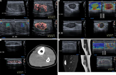 Examples of ultrasound findings and techniques. (A) Images in a 39-year-old male patient with a mass in the left thigh. The mass is heterogeneous on the B-mode US image (compared with the patient in D) and showed increased microvascularity (superb microvascular imaging [SMI]) and shear-wave elastography (SWE) values. Undifferentiated pleomorphic sarcoma was diagnosed at biopsy (with pleomorphic rhabdomyosarcoma in surgical specimen). (B) Images in an 18-year-old male patient with a mass in the left leg. The mass is hypoechoic on the B-mode image, with no other findings suggestive of malignancy. The lesion is in contact with the cortex of the tibia, which is slightly irregular. CT revealed a doubtful anteromedial tibial erosion. The microvascular study demonstrated high vascularization, suggestive of malignancy. Periosteal Ewing sarcoma was diagnosed with both histologic and immunohistochemical confirmation. (C) Images in a 69-year-old female patient with a lump growing on the outside of the left leg. Multiple SWE examinations were performed (please note the high values obtained in the measurements, whereas the color map highlights the stiffness relative to adjacent tissues). SMI showed areas of increased vascularization to target for sampling. Undifferentiated spindle cell sarcoma was diagnosed at biopsy, with residual leiomyosarcoma in the surgical specimen after neoadjuvant therapy. (D) Images in a 56-year-old female patient with a mass in the right thigh. The mass is heterogeneous at both B-mode ultrasound (similar to patient A) and MRI (coronal T2-weighted spectral attenuated inversion recovery [SPAIR]; T1-weighted pre-contrast and postcontrast imaging), which even shows uptake after the administration of paramagnetic contrast material, which is traditionally suggestive of malignancy. Low values at SMI and elastography are suggestive of benignity. Spindle cell lipoma was diagnosed at biopsy, with atypical spindle cell lipomatous tumor in the surgical specimen.