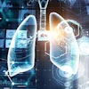 Lung Ai