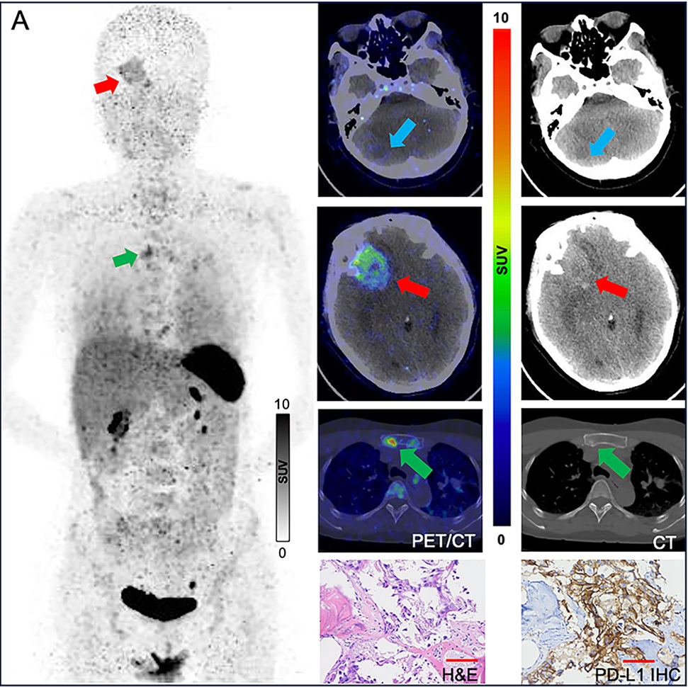 (A) Ga-68 NK224 PET/CT maximum intensity projection image (left), axial PET/CT images (center), and axial CT images (right) in a 43-year-old female participant with lung adenocarcinoma show lesions in the right cerebellum (blue arrow), right frontal lobe (red arrow), and sternum (green arrow) with low, intermediate, and high tracer uptake, respectively. Photomicrographs (scale bar, 100 μm) with hematoxylin-eosin (H&E) staining (center bottom) and programmed death ligand 1 (PD-L1) immunohistochemical (IHC) staining (right bottom) show high PD-L1 expression in the sternal lesion (tumor proportion score ≥ 50%).